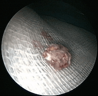 Aspergillome du sinus maxillaire retiré par chirurgie endonasale