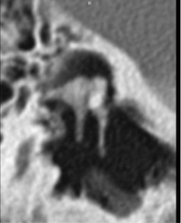 otospongiose gauche au scanner de l'oreille