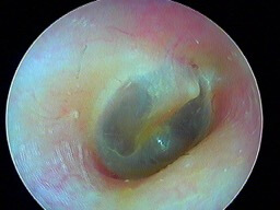 oreille droite normale en otoendoscopie