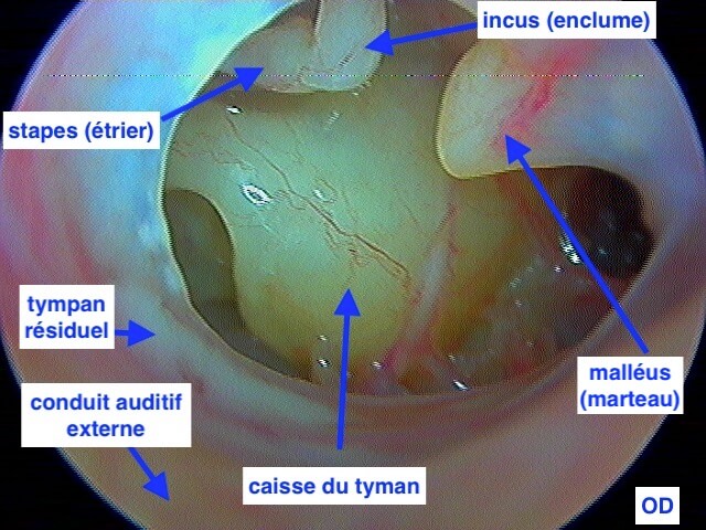 Otoscope professionnel pour examen de l'oreille